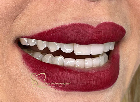 طراحی لبخند