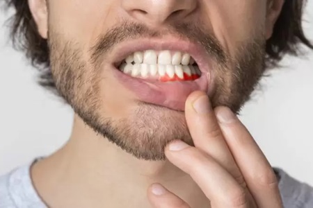 خونریزی هنگام مسواک زدن