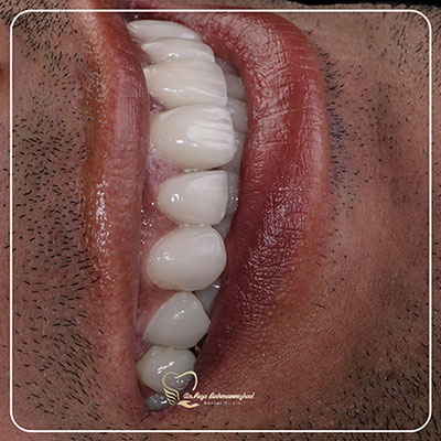 لمینت ایمکس سرامیکی