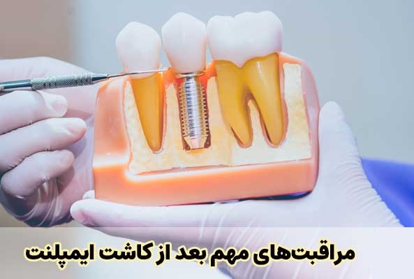 مراقبت های مهم بعد از کاشت ایمپلنت | دکتر رضا بهمن نژاد | بهترین دندانپزشک اهواز