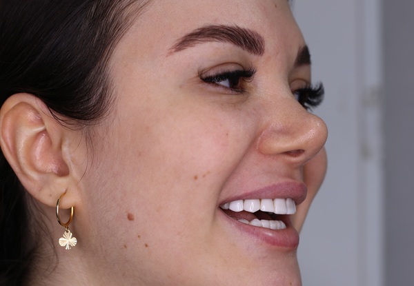 لمینت اهواز | دکتر رضا بهمن نژاد